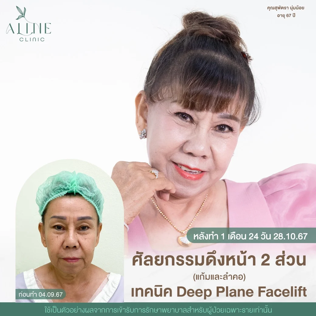 ดึงหน้า