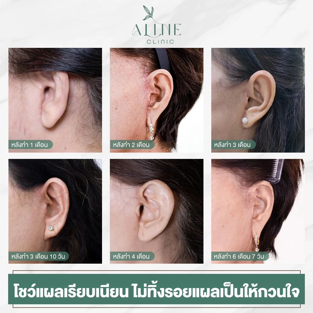 แผลดึงหน้าอลีนคลินิก