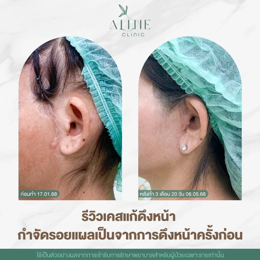 แก้แผลดึงหน้าอลีนิคคลินิก