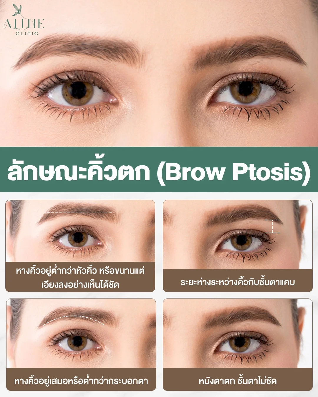 ลักษณะคิ้วตก brow ptosis