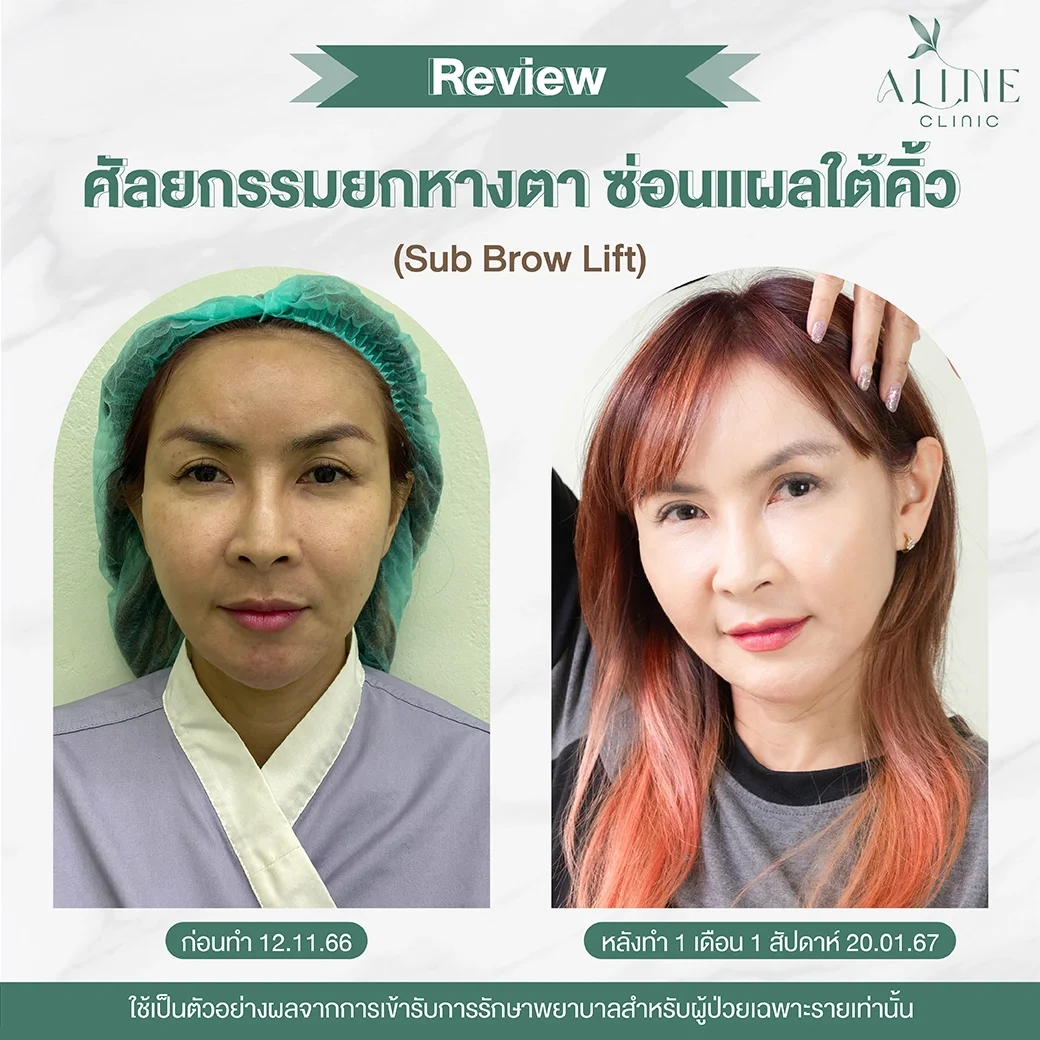 sub brow lift sub brow lift