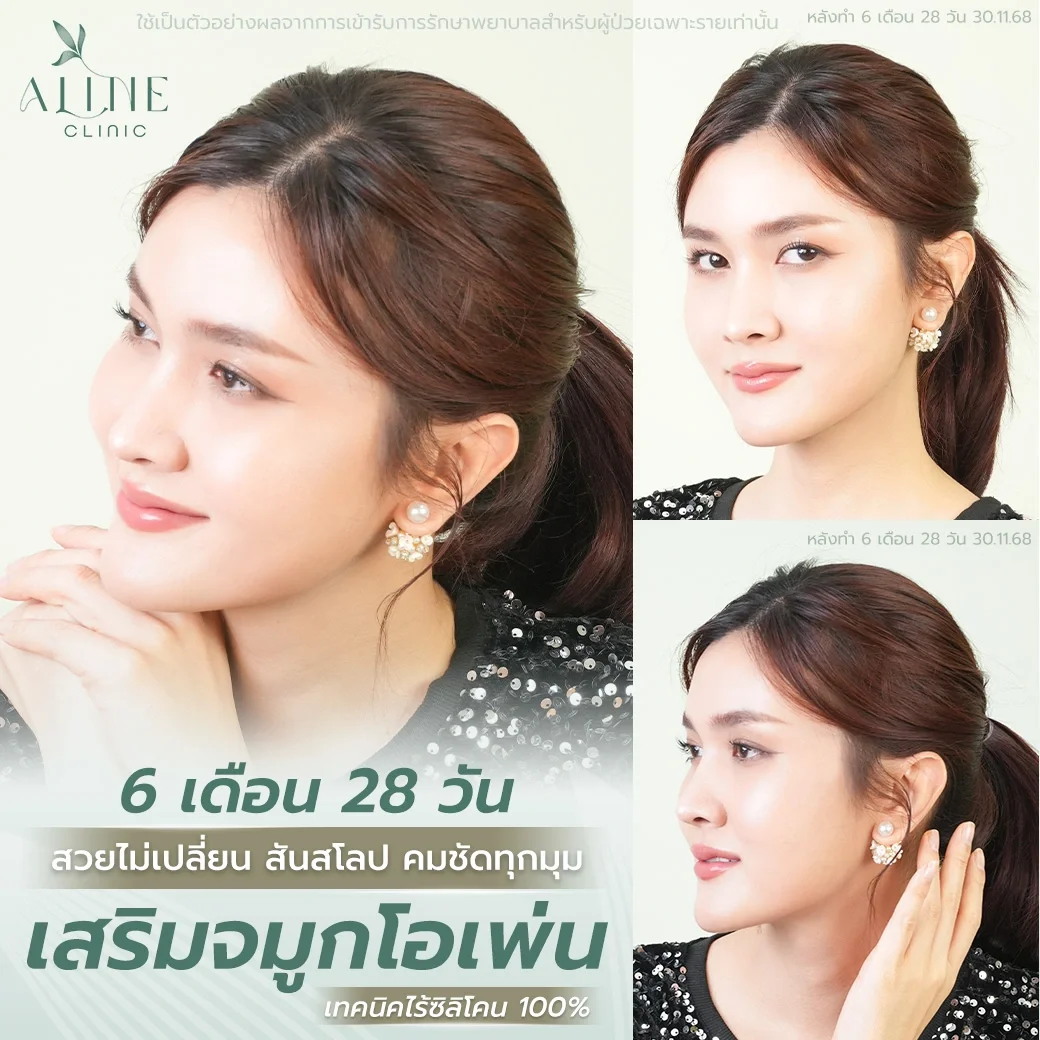 เสริมจมูกโอเพ่น