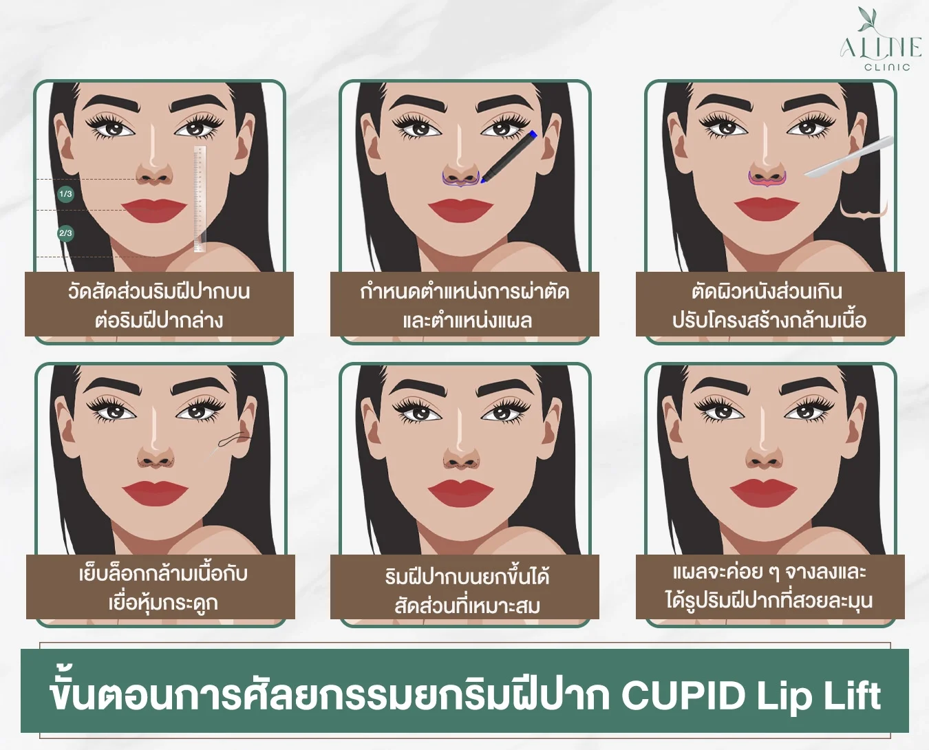 ขั้นตอนการทำศัลยกรรมยกริมฝีปากบน