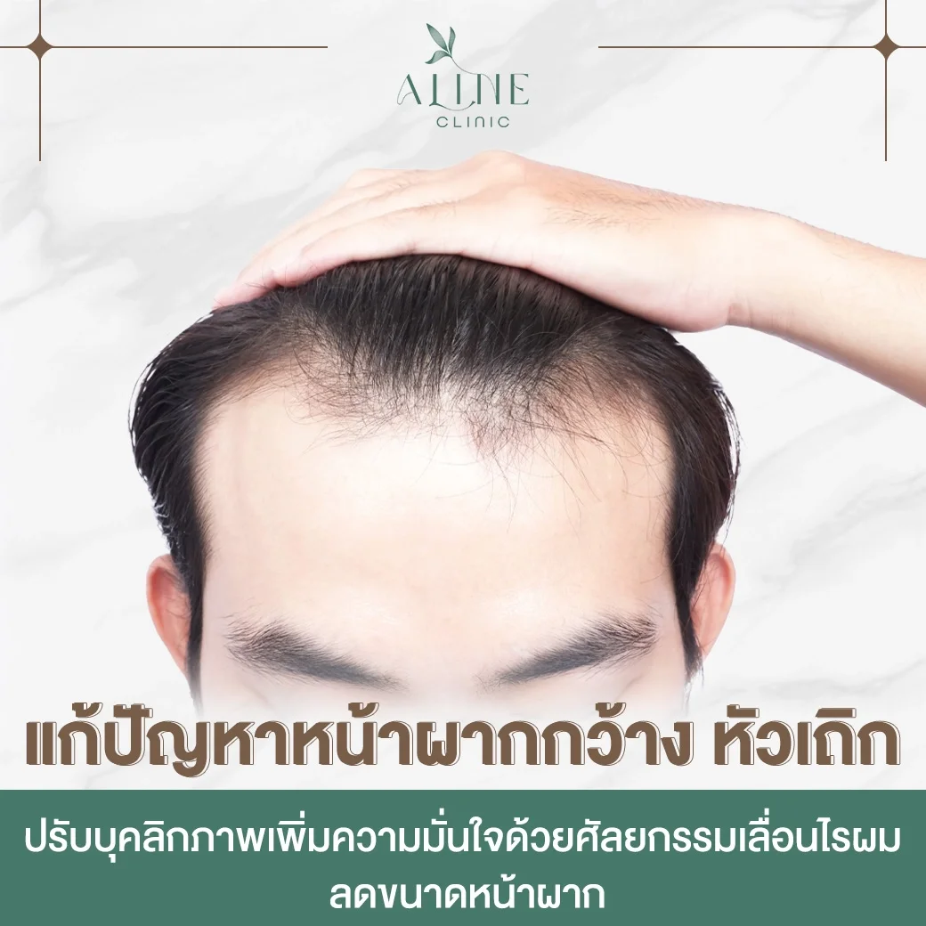 แก้ปัญหาหน้าผากกว้าง หัวเถิก ศัลยกรรมเลื่อนไรผม ลดขนาดหน้าผาก