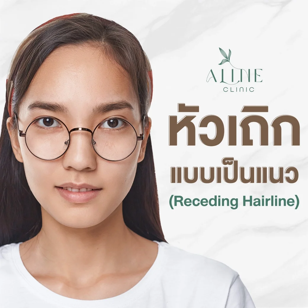 หัวเถิกแบบเป็นแนว Receding Hairline