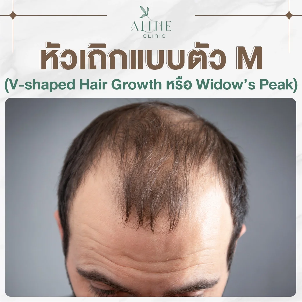 หัวเถิกแบบตัว M 