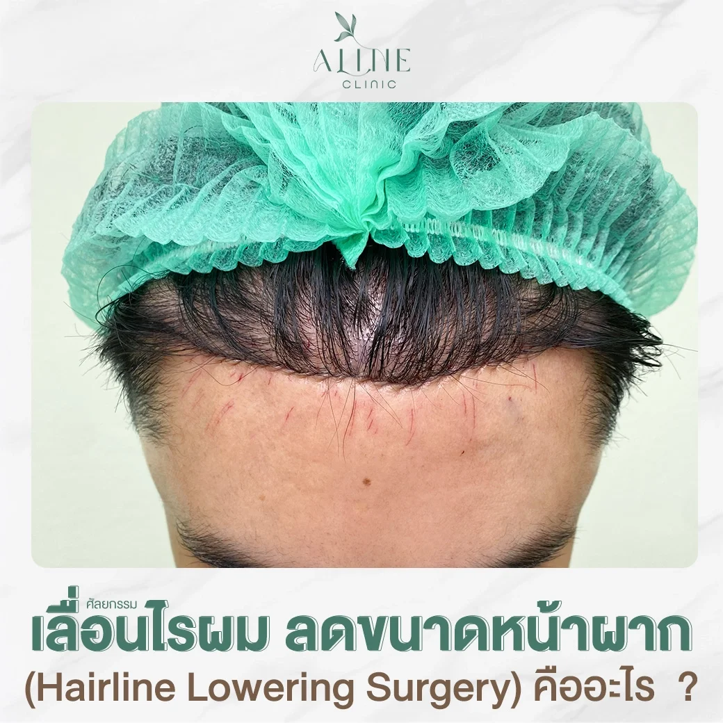 ศัลยกรรมเลื่อนไรผม ลดขนาดหน้าผาก Hairline Lowering Surgery คืออะไร  