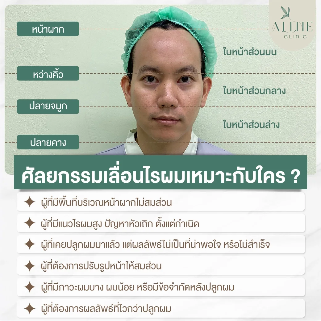 ศัลยกรรมเลื่อนไรผม ลดขนาดหน้าผาก เหมาะกับใคร