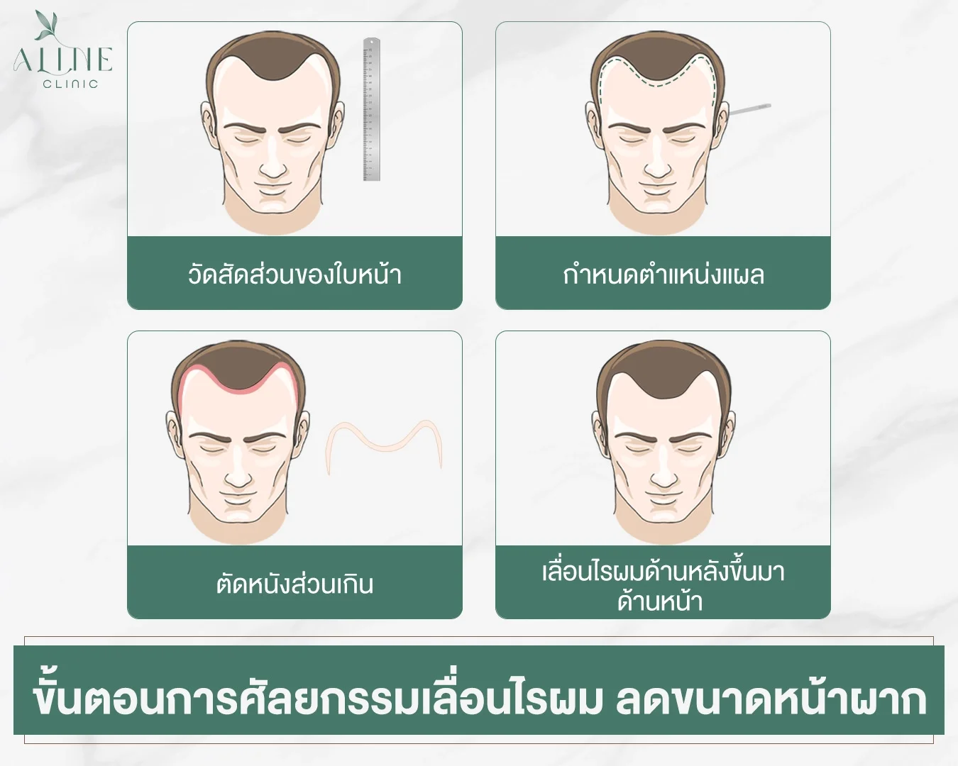 ขั้นตอนการทำศัลยกรรมเลื่อนไรผม ลดขนาดหน้าผาก