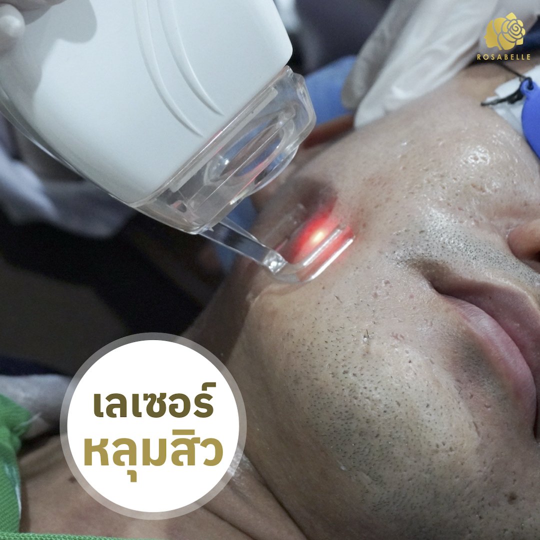 เลเซอร์หลุมสิว