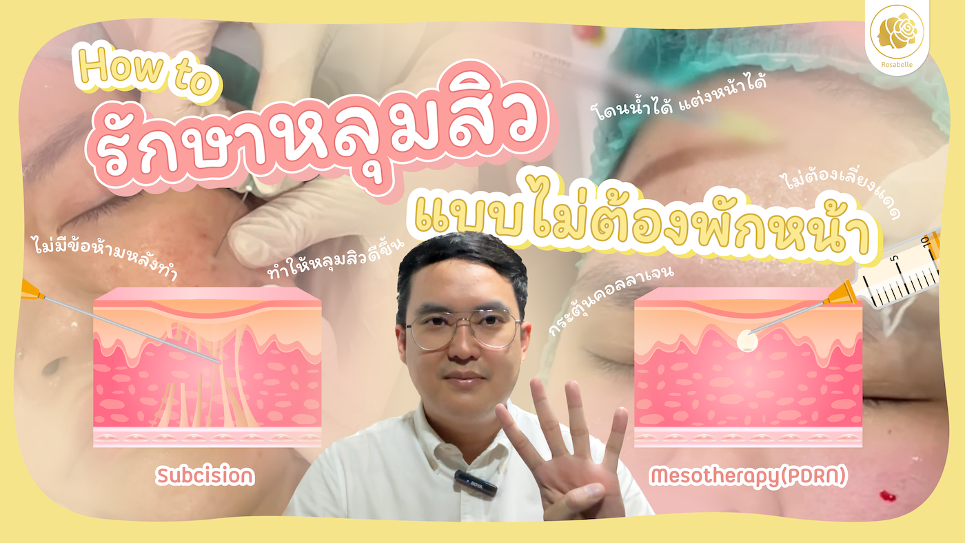 วิธีรักษาหลุมสิวแบบไม่ต้องพักหน้า ที่โรสเบลล์คลินิก