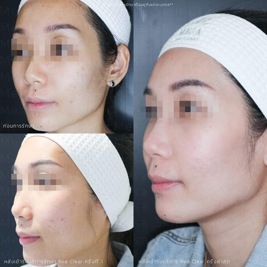 รักษารอยแดงสิว Red Clear