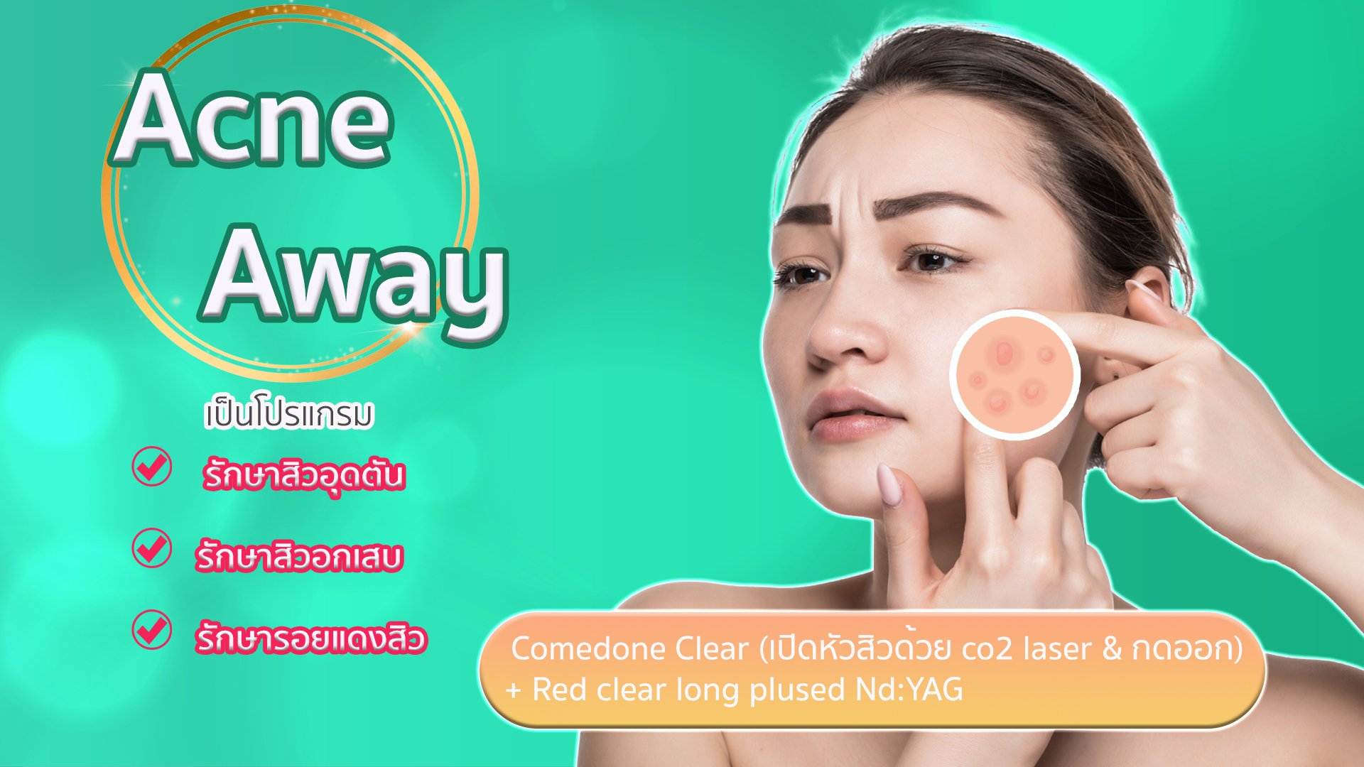 Acne A Way
