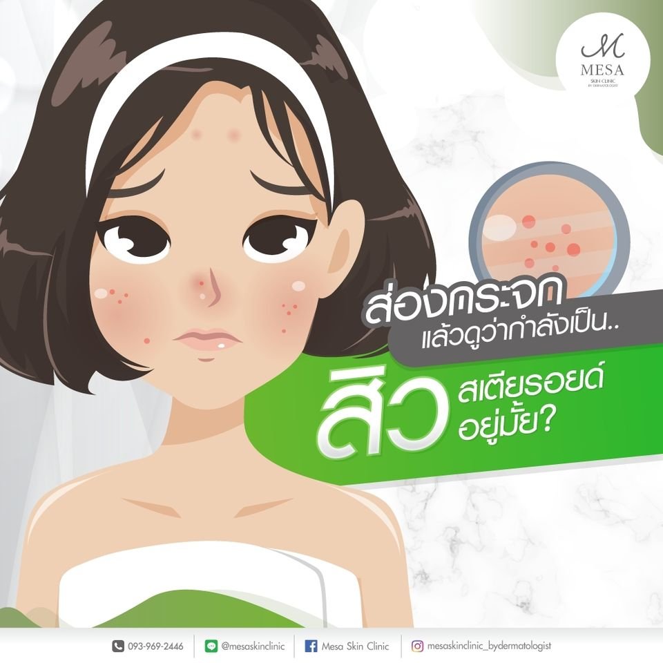 ส่องกระจกแล้วดูว่ากำลังเป็นสิวสเตียรอยด์อยู่ไหม ส่องกระจกแล้วดูว่ากำลังเป็นสิวสเตียรอยด์อยู่ไหม