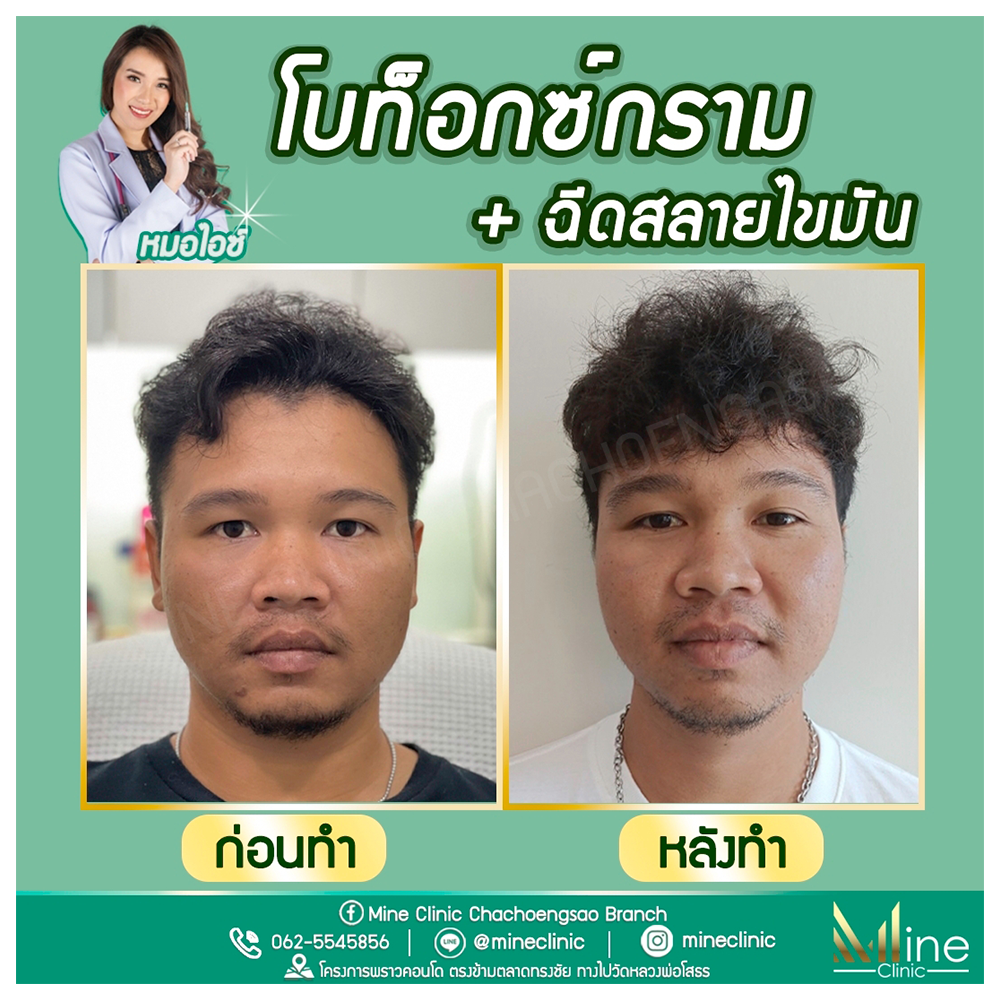 โบท็อกซ์กราม