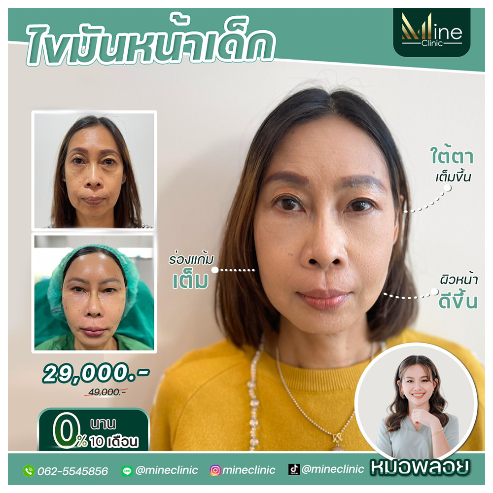 ไขมันหน้าเด็ก Mine Clinic