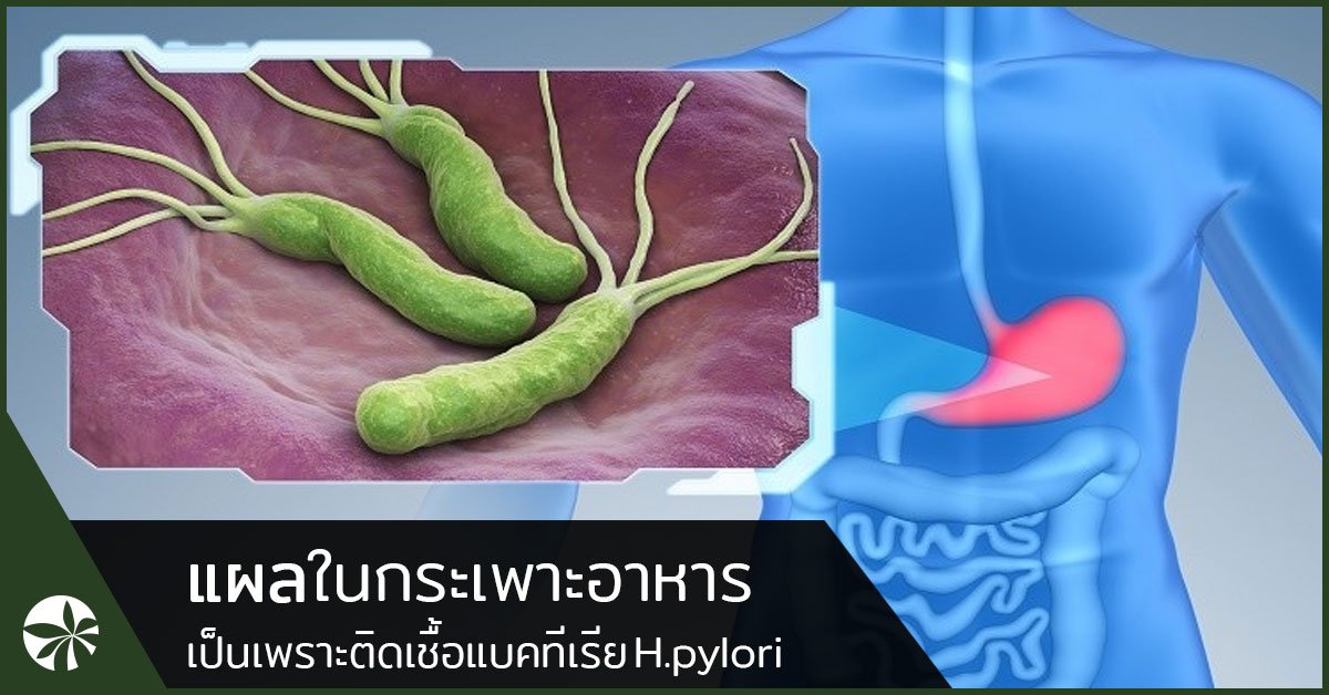 แบคทีเรีย H.Pylori ก่อโรคกระเพาะอาหาร