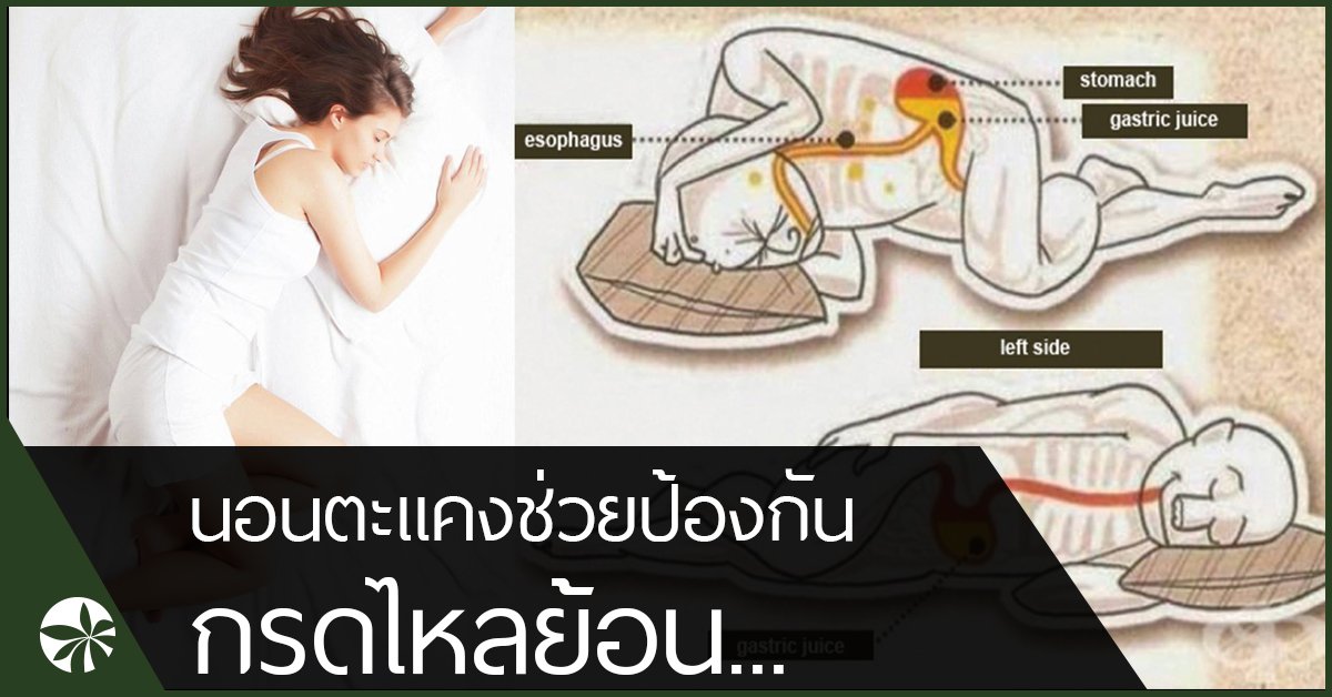 นอนตะแคง ป้องกันกรดไหลย้อน  นอนตะแคง ป้องกันกรดไหลย้อน