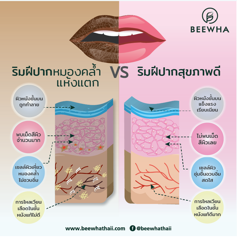 ชั้นผิวหนังของริมฝีปากดำคล้ำแห้งแตก เปรียบเทียบกับริมสีปากสุขภาพดี