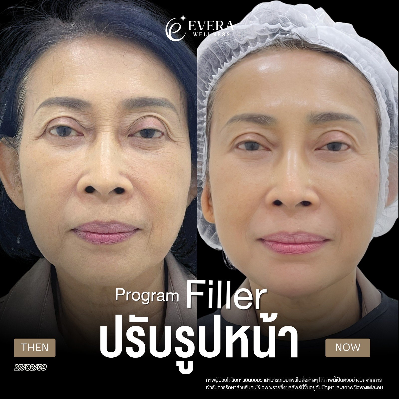 ภาพก่อนและหลังรับบริการฟิลเลอร์ ปรับรูปหน้า — มุมตรง