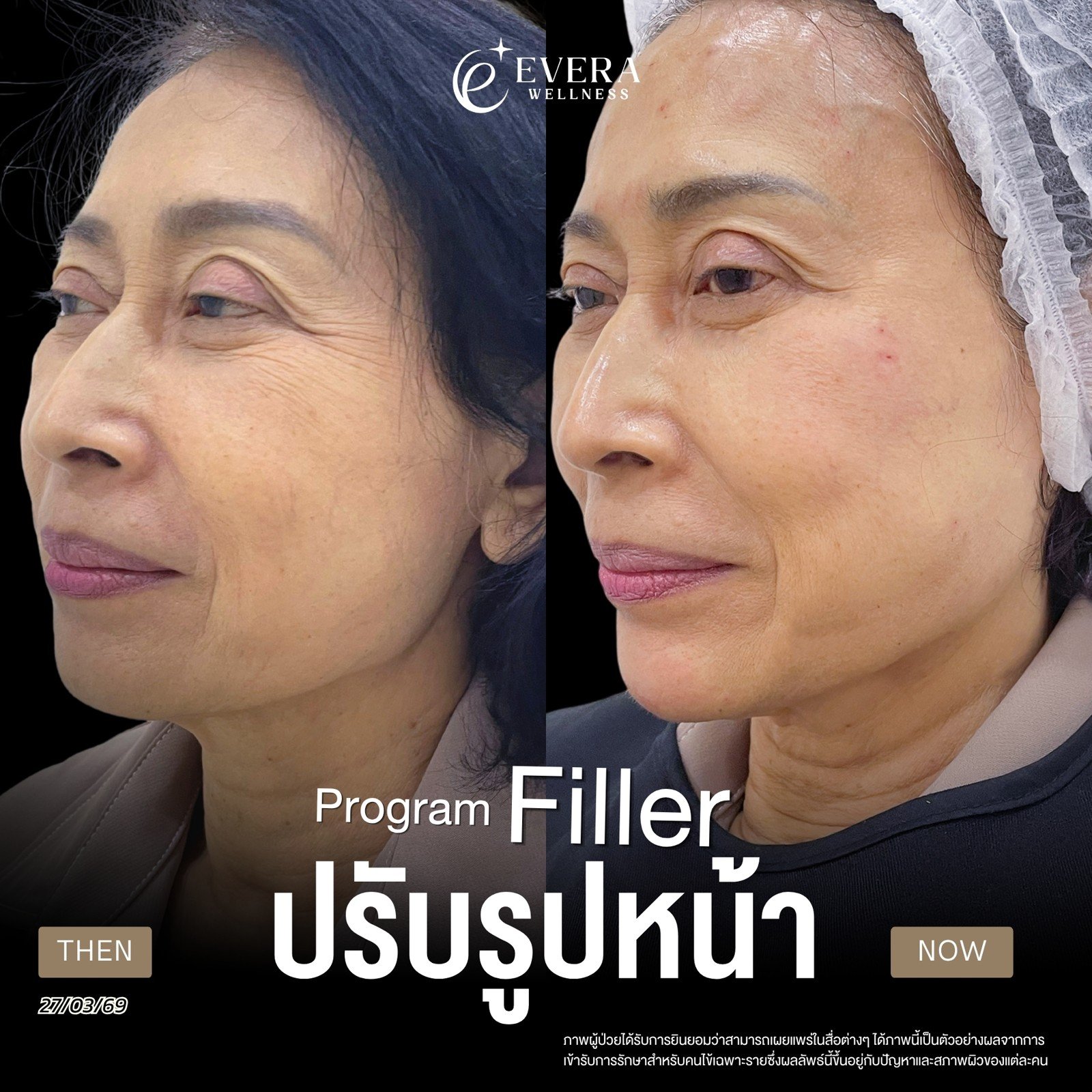 ภาพก่อนและหลังรับบริการฟิลเลอร์ ปรับรูปหน้า — มุมด้านข้าง
