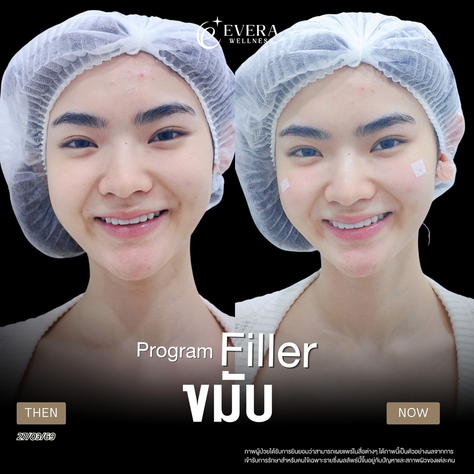 ภาพก่อนและหลังรับบริการฟิลเลอร์ ขมับ — มุมตรง