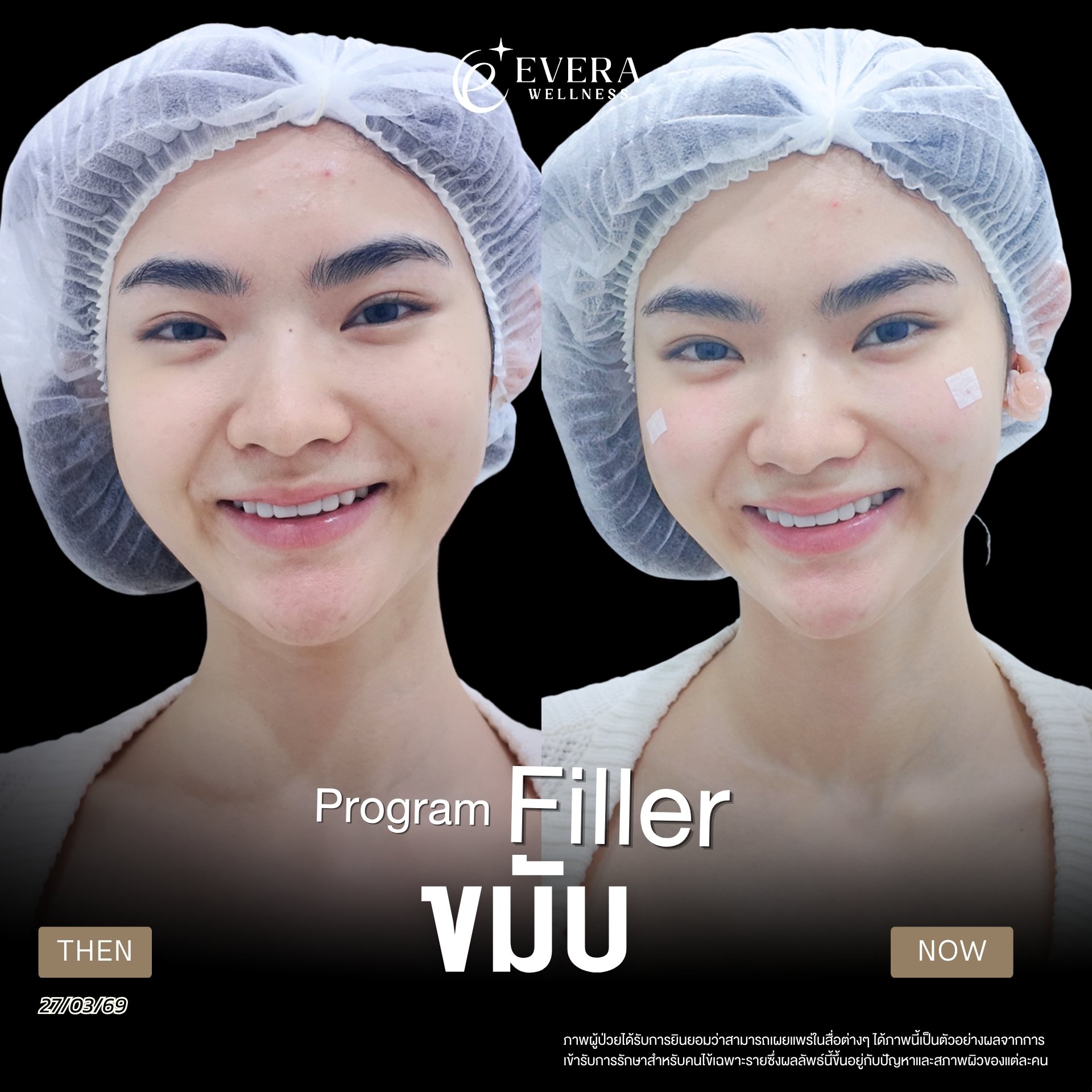 ภาพรีวิวโปรแกรม Filler ที่ผู้ใช้ส่ง รูปที่ 2 พร้อมวันที่และข้อความกำกับ