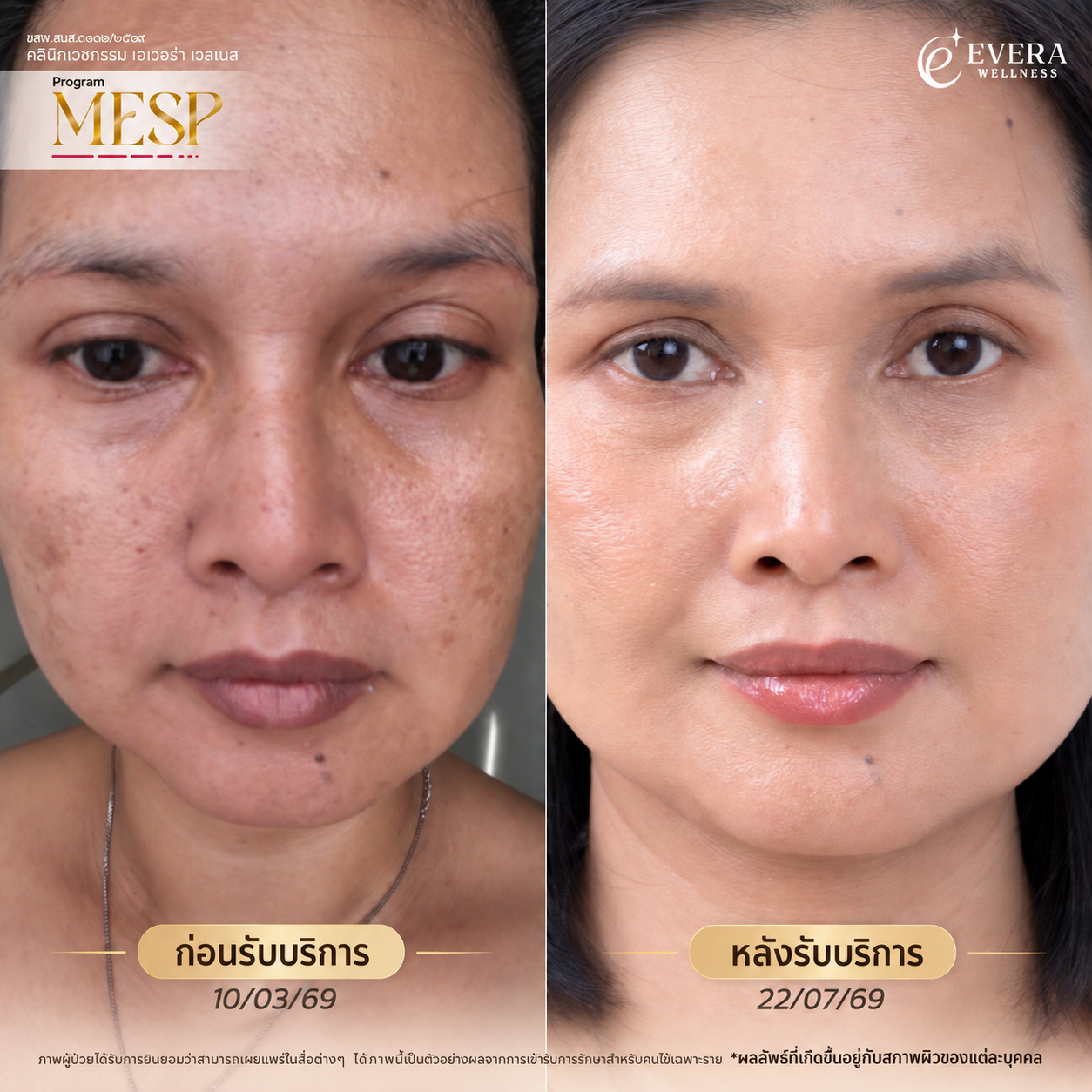 ภาพเปรียบเทียบก่อนและหลังรับบริการโปรแกรม MESP พร้อมวันที่และข้อความกำกับ