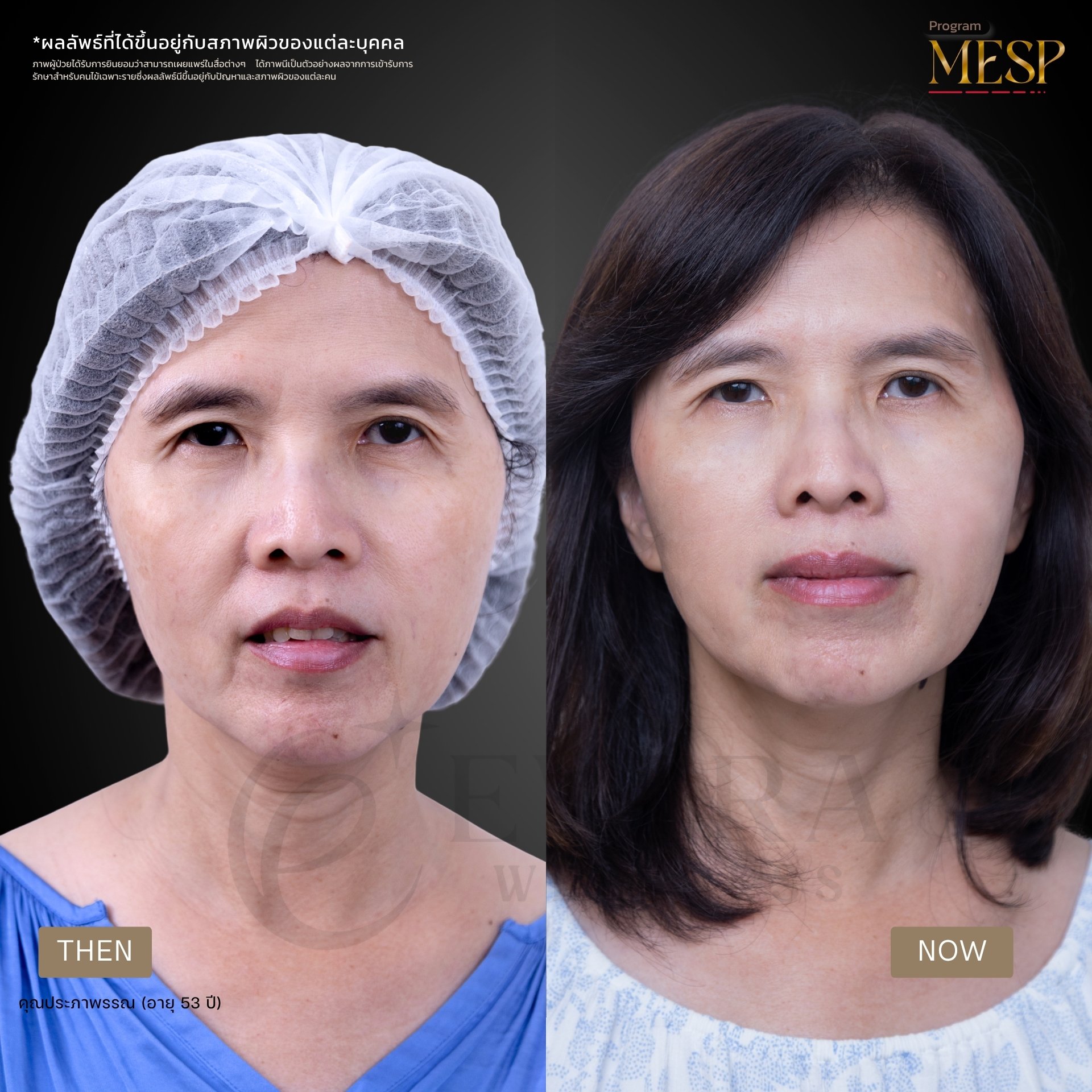 ภาพรีวิวโปรแกรม MESP ที่ผู้ใช้ส่ง รูปที่ 4 พร้อมข้อความกำกับ