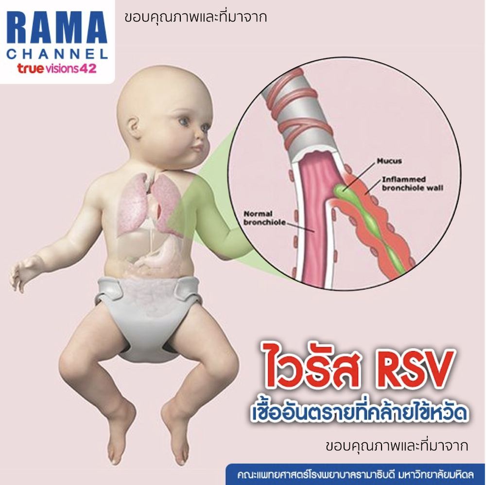 RSV เสมหะอุดกั้นขั้วปอด เด็กเสียชีวิตได้ อย่าหาว่านูสอนใช้ประกัน EP.11