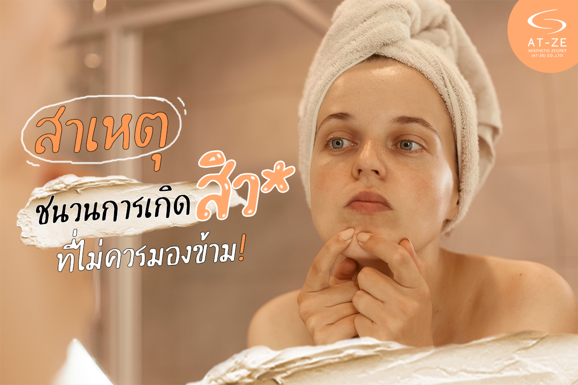 สาเหตุชนวนการเกิดสิว ที่ไม่ควรมองข้าม