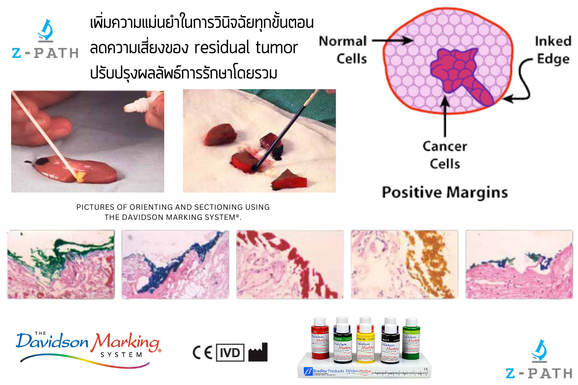 ค้นพบนวัตกรรมสีย้อมเนื้อเยื่อ- เพิ่มความแม่นยำในการวินิจฉัยมะเร็ง