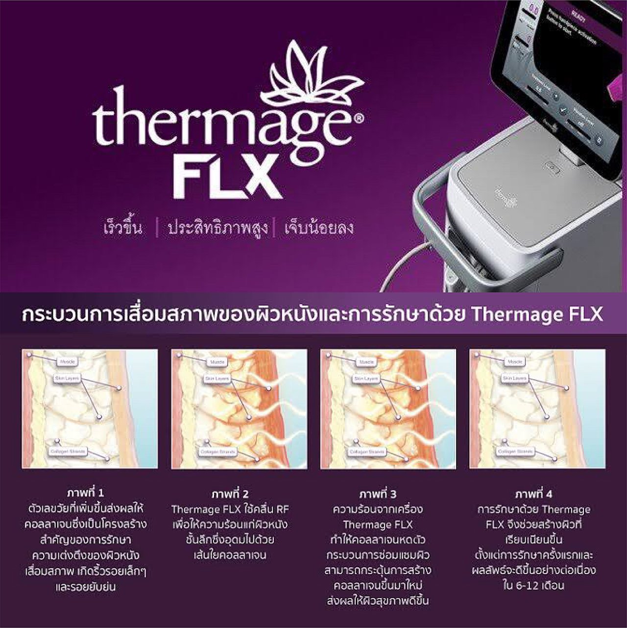 Thermage FLX Body Tip ดูแลปัญหาหน้าท้อง ต้นแขน ต้นขาไม่กระชับอย่างเห็นผล แบบ X 4