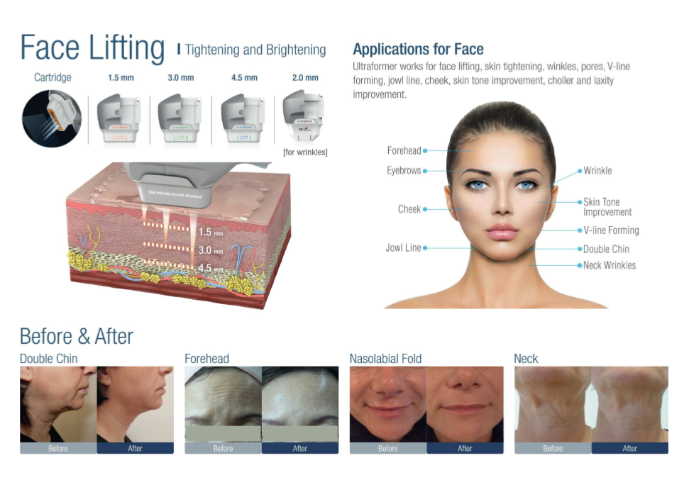 Ultraformer III Ultra HIFU นวัตกรรมใหม่ล่าสุดของการยกกระชับ คอร์ส 3 ครั้ง 19,000 บ. Ultraformer III Ultra HIFU นวัตกรรมใหม่ล่าสุดของการยกกระชับ คอร์ส 3 ครั้ง 19,000 บ.