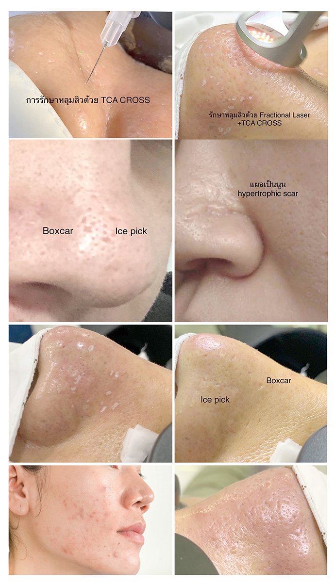 แนะนำเทคนิคดูแลหลุมสิว : แผลเป็นหลุมสิวที่จมูก ดูแลได้อย่างไรบ้าง ? แนะนำเทคนิคดูแลหลุมสิว : แผลเป็นหลุมสิวที่จมูก ดูแลได้อย่างไรบ้าง ?