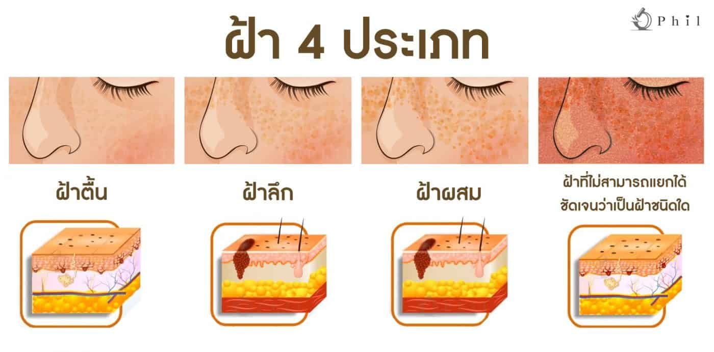 ฝ้ามีกี่ชนิด Melasma Type? ฝ้ามีกี่ชนิด Melasma Type?