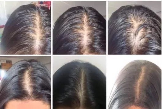โรคผมร่วงเป็นหย่อม Alopecia Areata AA มีลักษณะอย่างไรและรักษาได้อย่างไร ? โรคผมร่วงเป็นหย่อม Alopecia Areata AA มีลักษณะอย่างไรและรักษาได้อย่างไร ?