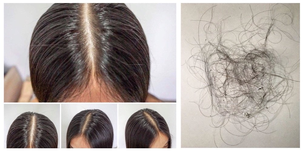 โรคผมร่วงเป็นหย่อม Alopecia Areata AA มีลักษณะอย่างไรและรักษาได้อย่างไร ? โรคผมร่วงเป็นหย่อม Alopecia Areata AA มีลักษณะอย่างไรและรักษาได้อย่างไร ?