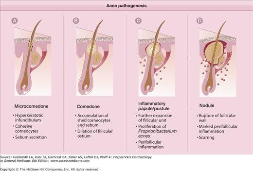 เป็นสิวจากการใส่หน้ากากอนามัยทำอย่างไรดี เป็นสิวจากการใส่หน้ากากอนามัยทำอย่างไรดี