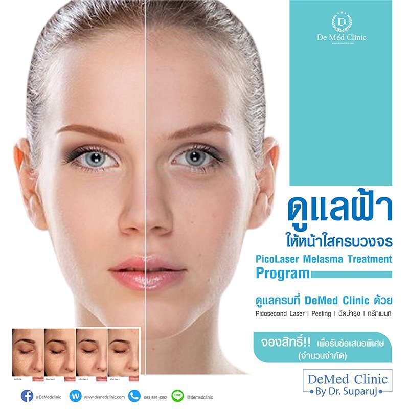 โปรแกรมฉีดรักษาฝ้า Channel Melasma Clear Program ที่ DeMed Clinic