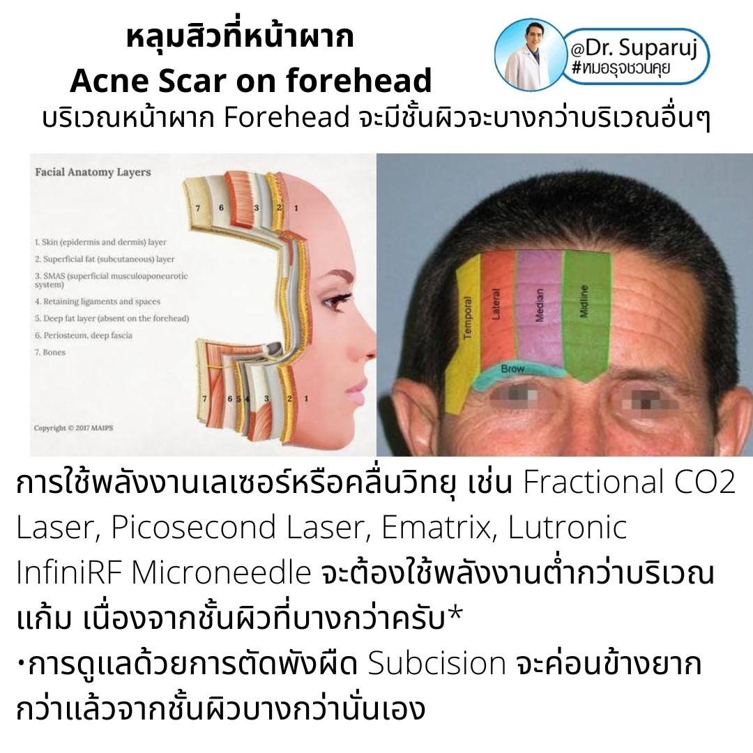 หลุมสิวที่หน้าผาก Acne Scar on forehead มีเทคนิคดูแลต่างจากบริเวณอื่นอย่างไร? หลุมสิวที่หน้าผาก Acne Scar on forehead มีเทคนิคดูแลต่างจากบริเวณอื่นอย่างไร?