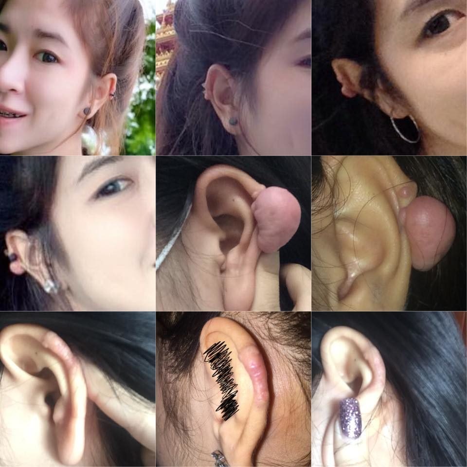 แนะนำเทคนิคดูแลแผลเป็นนูนคีลอยด์ Ep. 3 คีลอยด์ใบหู? Ear Keloid ดูแลได้อย่างไร? แนะนำเทคนิคดูแลแผลเป็นนูนคีลอยด์ Ep. 3 คีลอยด์ใบหู? Ear Keloid ดูแลได้อย่างไร?