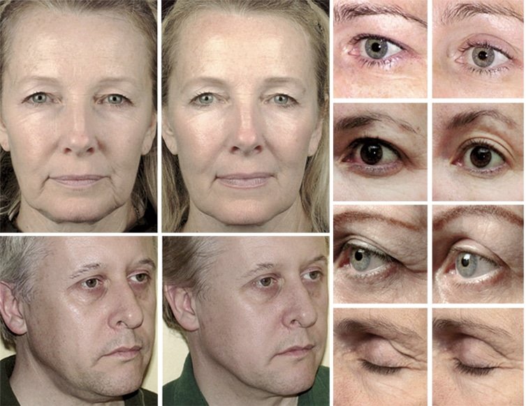 Thermage FLX นวัตกรรมยกกระชับผิว ทรงประสิทธิภาพเพื่อการปรับรูปหน้าเรียวเล็ก Thermage FLX นวัตกรรมยกกระชับผิว ทรงประสิทธิภาพเพื่อการปรับรูปหน้าเรียวเล็ก