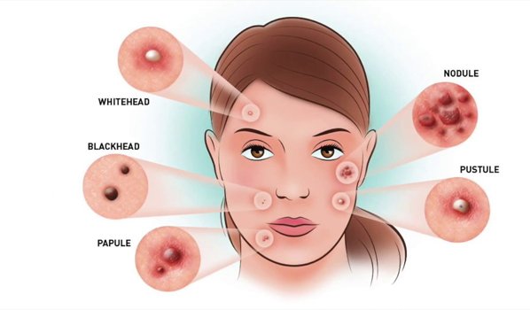 หลุมสิวบริเวณขมับดูแลรักษาได้อย่างไรบ้าง? หลุมสิวบริเวณขมับดูแลรักษาได้อย่างไรบ้าง?