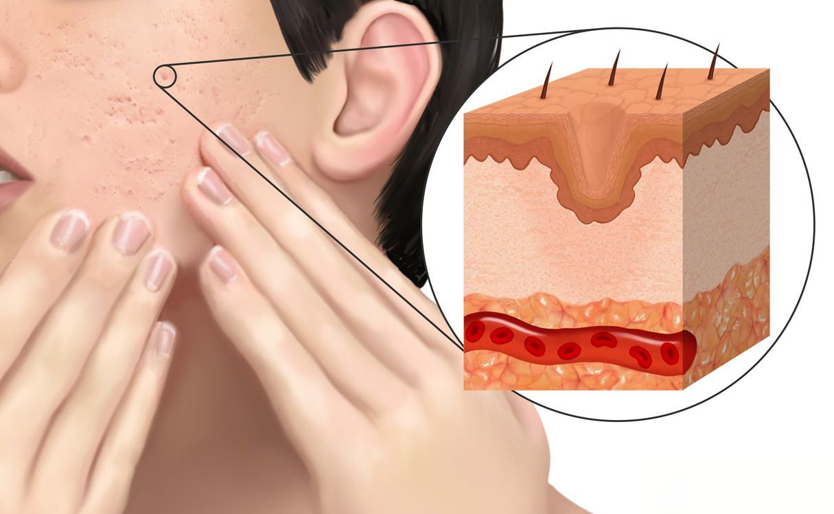 ดูแลรักษาหลุมสิวเทคนิคตัดพังผืดหลุมสิว  Special Subcision Technique 