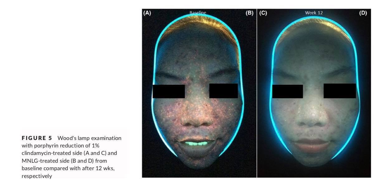 ทายารักษาสิวอย่างสม่ำเสมอช่วยรักษาสิวได้ผลจริงหรือ? ทายารักษาสิวอย่างสม่ำเสมอช่วยรักษาสิวได้ผลจริงหรือ?