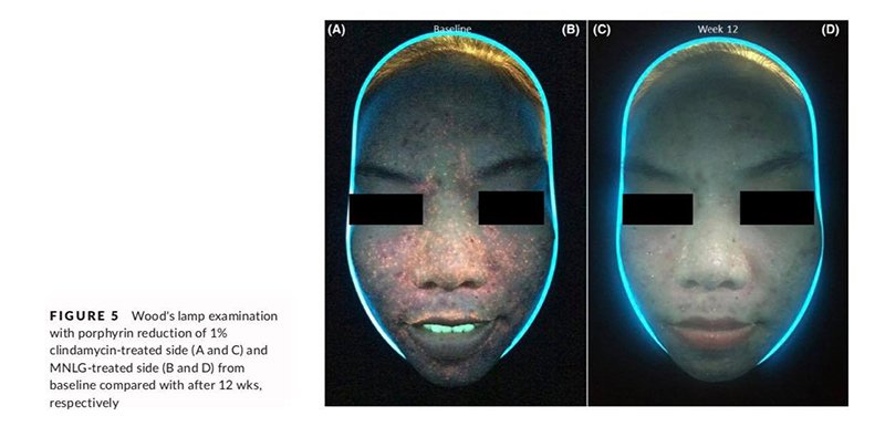 ทายารักษาสิวอย่างสม่ำเสมอช่วยรักษาสิวได้ผลจริงหรือ ? ทายารักษาสิวอย่างสม่ำเสมอช่วยรักษาสิวได้ผลจริงหรือ ?
