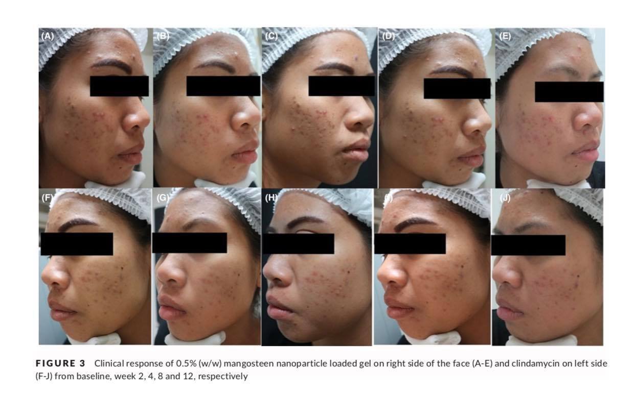 ทายารักษาสิวอย่างสม่ำเสมอช่วยรักษาสิวได้ผลจริงหรือ? ทายารักษาสิวอย่างสม่ำเสมอช่วยรักษาสิวได้ผลจริงหรือ?