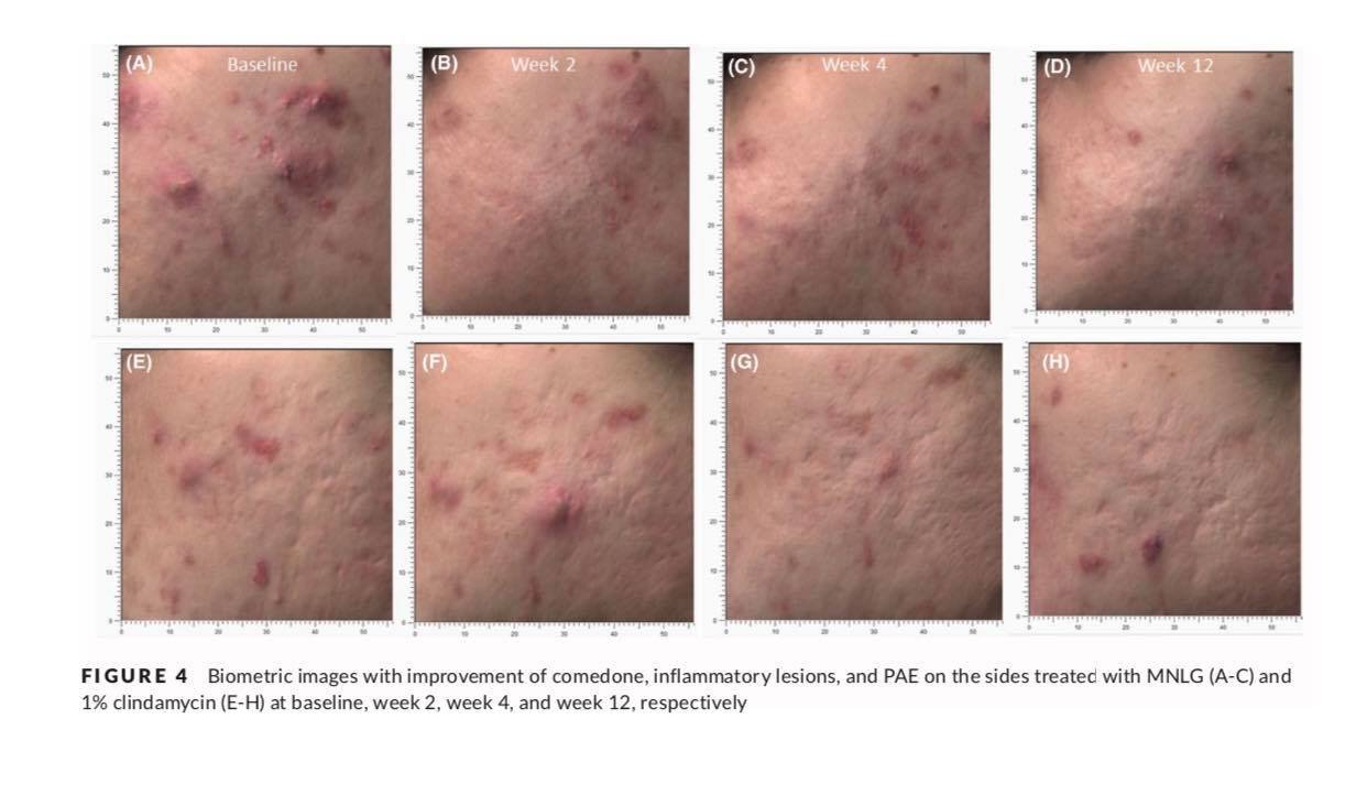 ทายารักษาสิวอย่างสม่ำเสมอช่วยรักษาสิวได้ผลจริงหรือ? ทายารักษาสิวอย่างสม่ำเสมอช่วยรักษาสิวได้ผลจริงหรือ?
