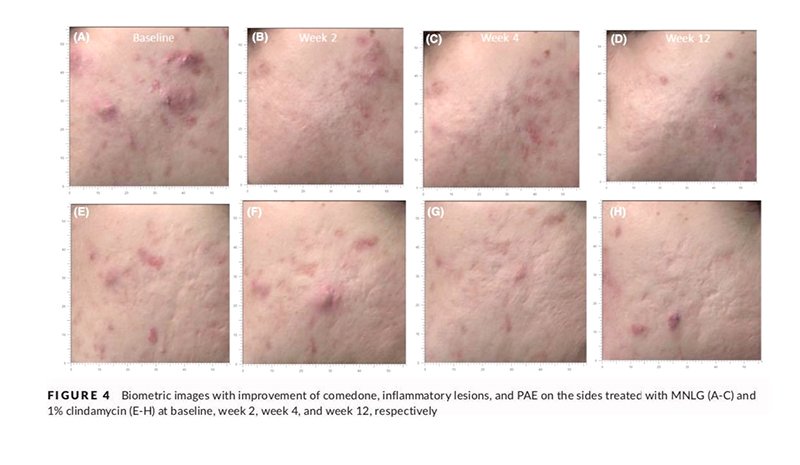 ทายารักษาสิวอย่างสม่ำเสมอช่วยรักษาสิวได้ผลจริงหรือ ? ทายารักษาสิวอย่างสม่ำเสมอช่วยรักษาสิวได้ผลจริงหรือ ?